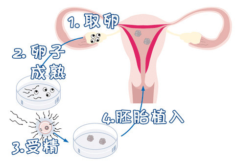 试管代孕费用多少